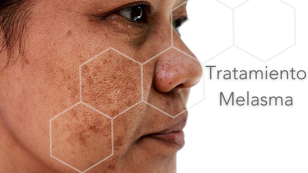 Tratamiento para Melasma