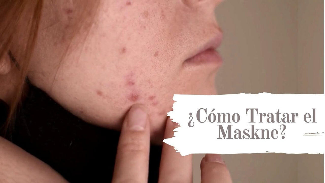Cómo Tratar el Maskne: Acné causado por la Mascarilla