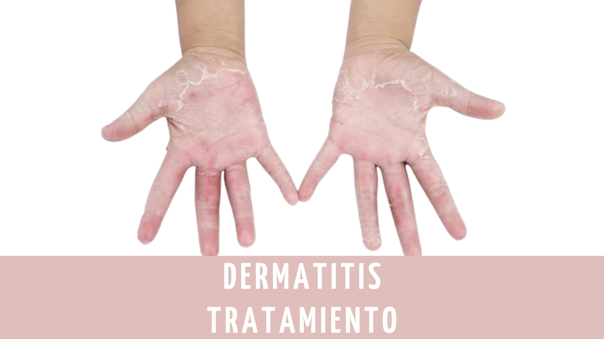 crema-para-dermatitis