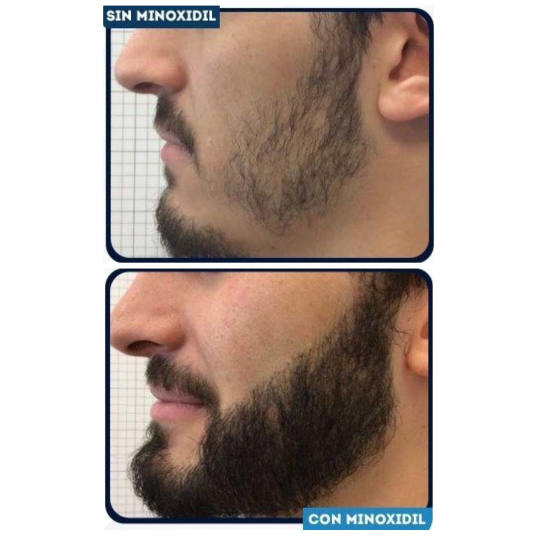     minoxidil-barba